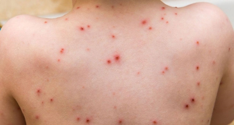 Kulaktan dolma bilgileri unutun! Maymun Çiçeği virüsü hakkında bilinmesi gerekenler - Resim: 4