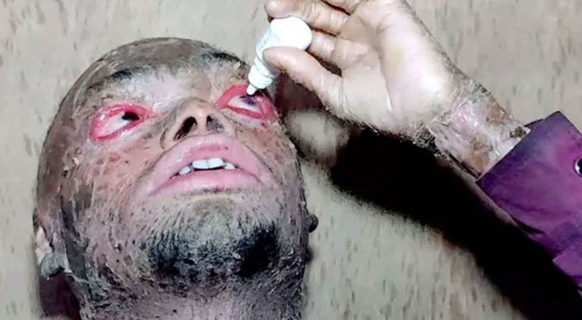 Hastalığına inanamayacaksınız! Her hafta deri değiştiriyor, çocuklar ondan kaçıyor - Resim: 3