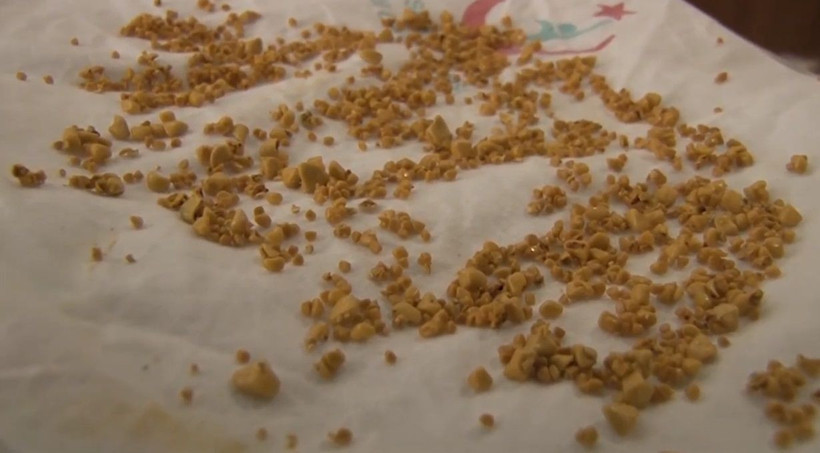 Karın ağrısıyla hastaneye gitti! Doktorlar gözlerine inanamadı - Resim: 4