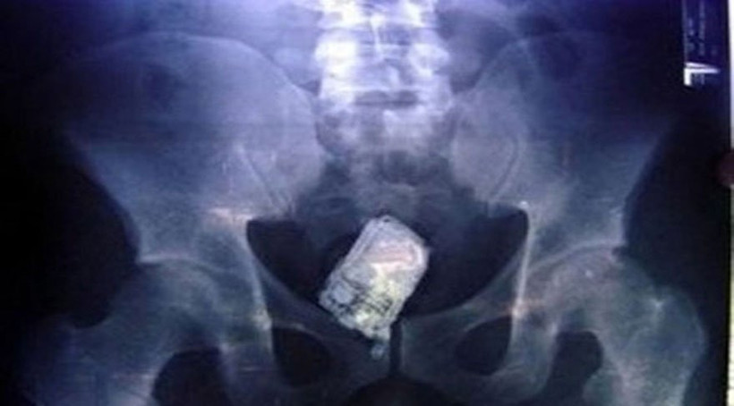 Akıllara durgunluk veren olay anüsünden topçu mermisi çıktı! - Resim: 1