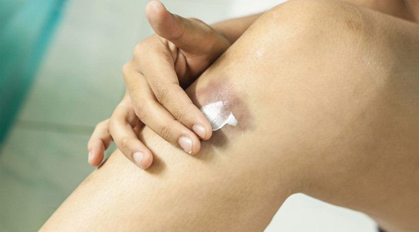 Ciltte morarma sebepleri morluklar nasıl geçer? - Resim: 4