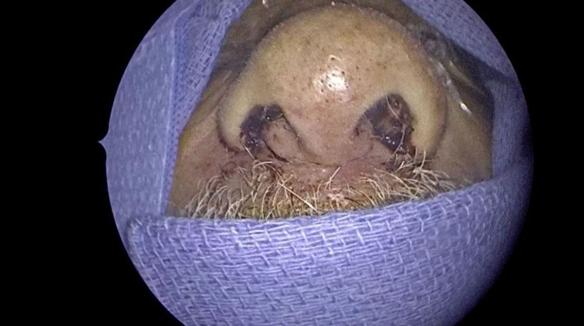 Doktorlar inanamadı! Burnundan 150 canlı kurtçuk çıkarıldı! - Resim: 2