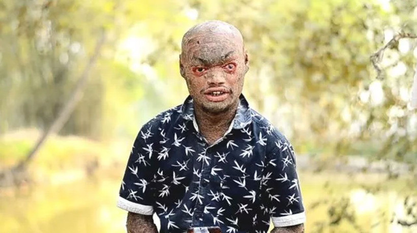 Hastalığına inanamayacaksınız! Her hafta deri değiştiriyor, çocuklar ondan kaçıyor - Resim: 2