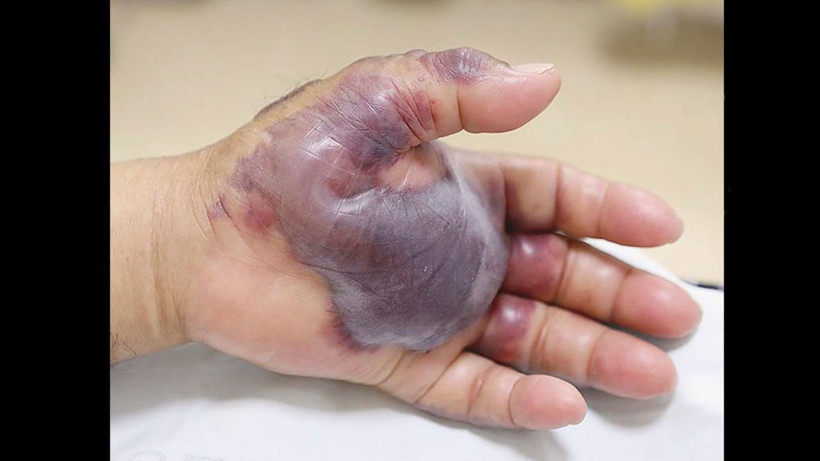 Ünlü şarkıcı et yiyen bakteri kaptı! Yüzünü yemeye başladı hızla yayılıyor - Resim: 1