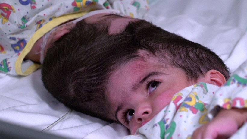 Dünya bu ameliyatı konuşuyor 100 doktor girdi 50 saatte yapışık ikizler birbirinden ayrıldı - Resim: 2