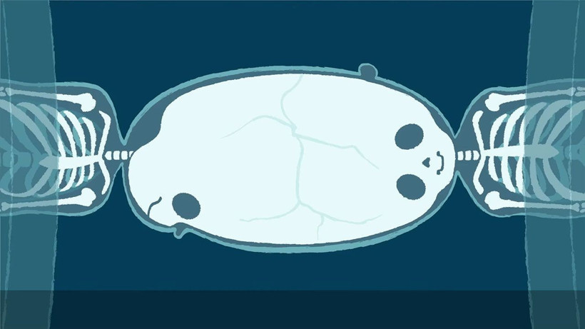 Dünya bu ameliyatı konuşuyor 100 doktor girdi 50 saatte yapışık ikizler birbirinden ayrıldı - Resim: 4