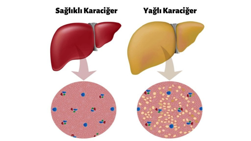 Bu besinler karaciğer yağlanmasını önlüyor - Resim: 1