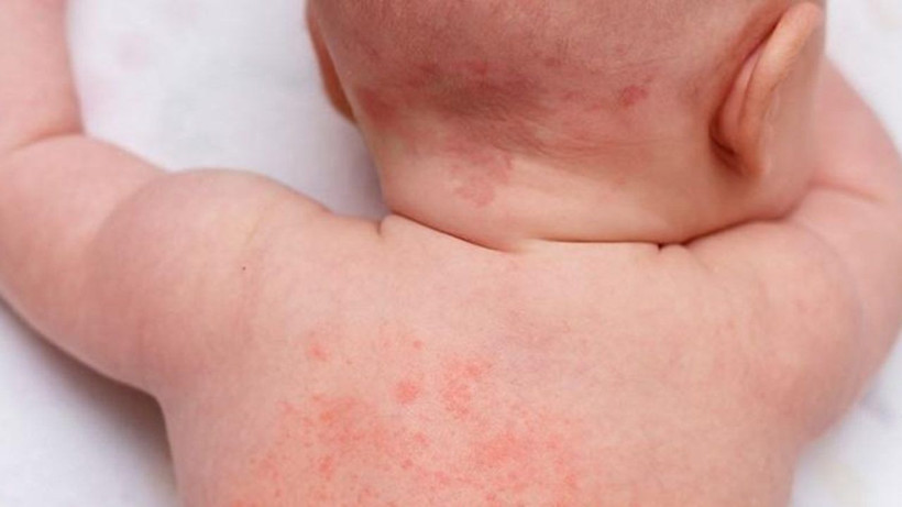 Uzmanı açıkladı! İşte yenidoğan bebeklerde en sık görülen cilt hastalıkları - Resim: 2