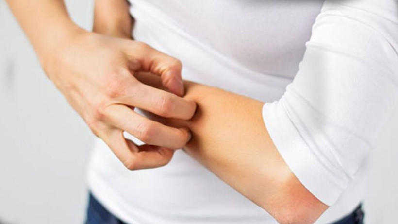 Uzmanı uyardı! Mevsim geçişlerinde alerjik egzamaya dikkat...Nelere dikkat edilmeli - Resim: 3