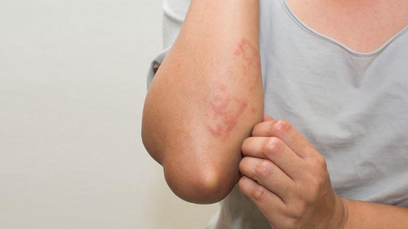 Uzmanı uyardı! Mevsim geçişlerinde alerjik egzamaya dikkat...Nelere dikkat edilmeli - Resim: 4