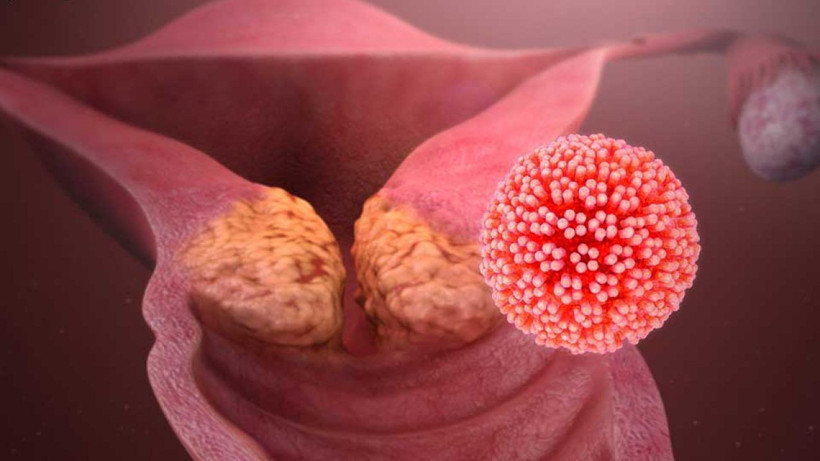 Rahim ağzı kanserine tarama testiyle erken tanı imkanı - Resim: 2