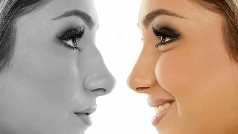 Uzmanı açıkladı! Estetik burun ameliyatı yaşam kalitesini arttırıyor - Resim: 4