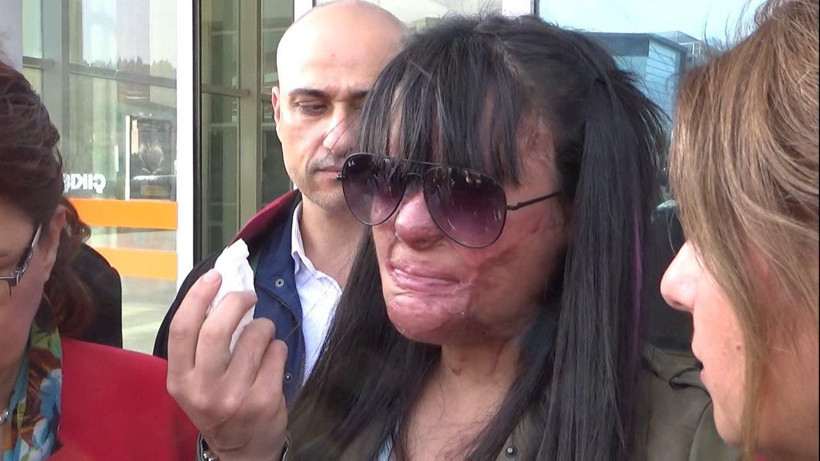 Yüzü asitle yakılan Berfin Özek ilk kez mahkemede - Resim: 3