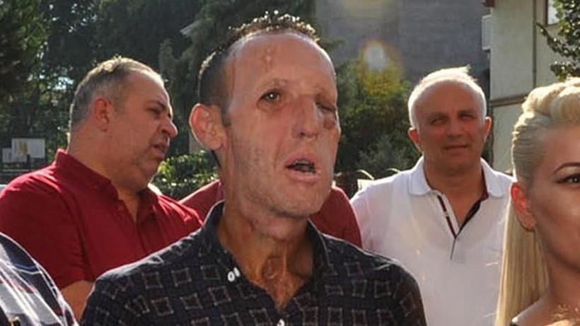 Yüz nakilli Recep Sert'ten kötü haber! Eşi Esma Sert açıkladı - Resim: 3