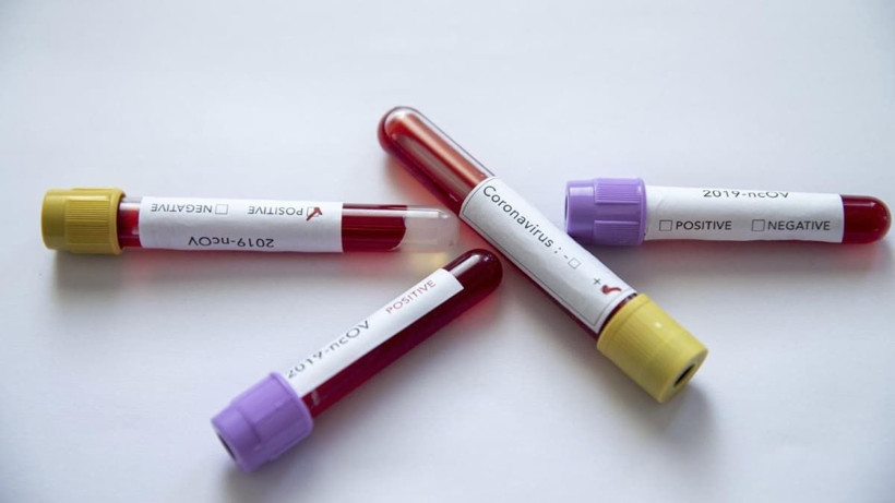 Tüm dünyada koronavirüse karşı aşı ve ilaç geliştirmedeki son çalışmalar umut verdi - Resim: 3