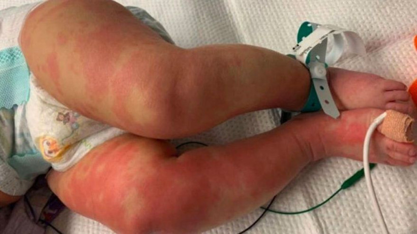 Yeni salgın! Korona bağlantılı 6 ülkede 100 çocukta görüldü acil uyarı geçildi - Resim: 3