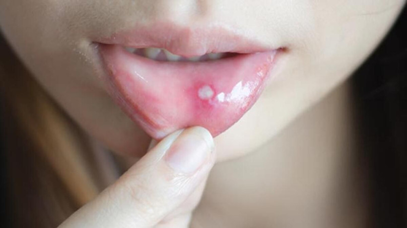 Aft nedir yemek yemeyi zorlaştırıyor sumak iyileştirir mi? - Resim: 3