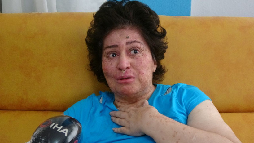 Korona değil güneş eve hapsetti her gün parça parça organları kesiliyor - Resim: 1