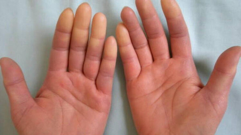 Raynaud fenomeni nedir meslek hastalığı mı damarları etkiliyor! - Resim: 2