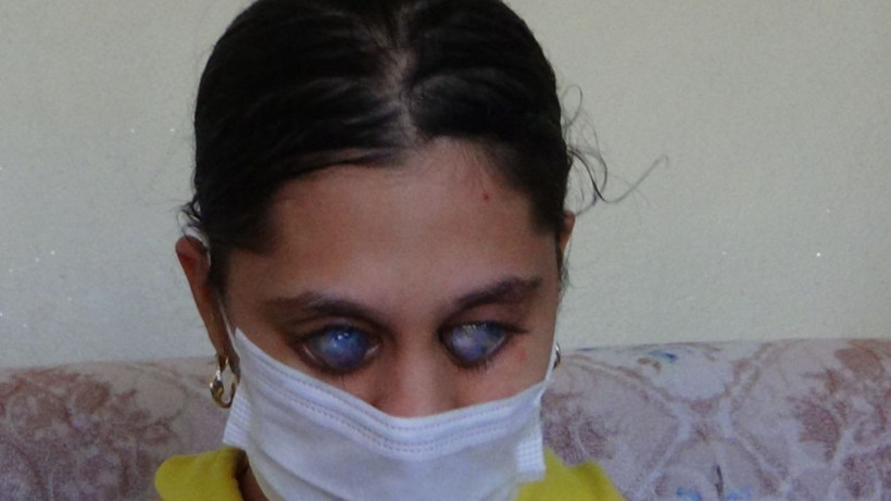 Ümran Dut için Sağlık Bakanlığı harekete geçti Herkes gözlerini 'photoshop' sanıyor - Resim: 1