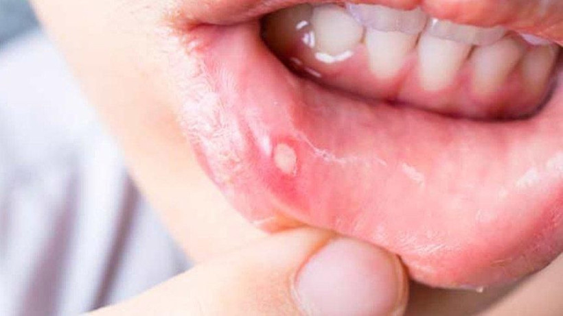 Ağızdaki aft nasıl geçer doğal yöntemler neler? - Resim: 1