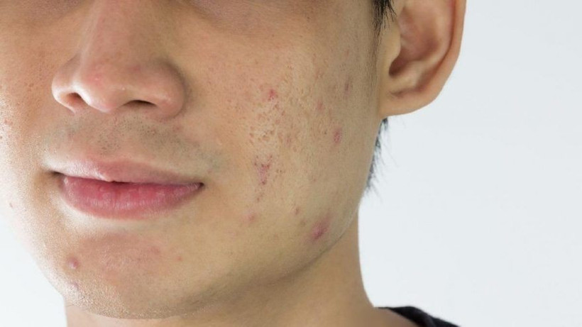 Sivilce nasıl geçer? Sivilcelerinizden kurtulmanın yolu bitkilerde saklı! - Resim: 3