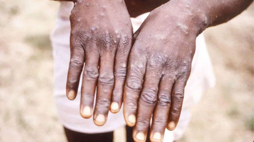 "Maymun Çiçeği hastalığı Türkiye'de" iddiası! DSÖ'den korkutan uyarı cinsel yolla bulaşıyor - Resim: 3