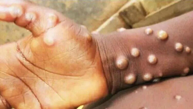 Kulaktan dolma bilgileri unutun! Maymun Çiçeği virüsü hakkında bilinmesi gerekenler - Resim: 1