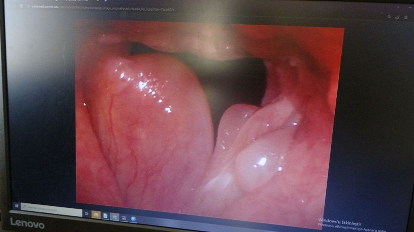 Ses kısıklığı yaşayanlar için uzman isimden önemli uyarı - Resim: 3