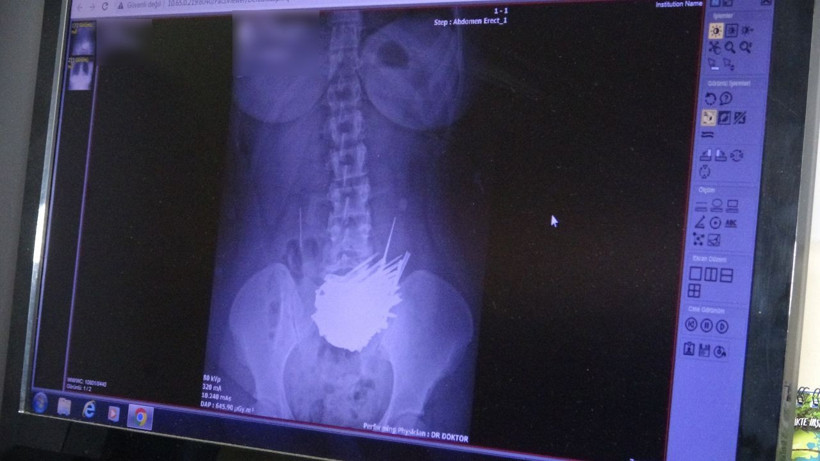 Hepsini yutmuş! Van'da genç kadının midesinden çıktı herkes şaşkın - Resim: 2