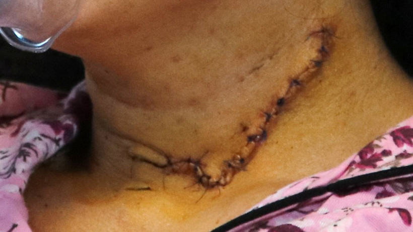 Adana'da dehşeti yaşadı! Midesinin yüzde 30'u alınan Burcu'ya 135 dikiş atıldı - Resim: 2