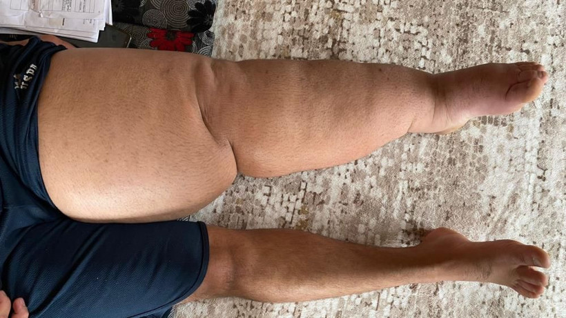 5 yıldır gitmediği hastane kalmadı: Kaza sonrası ayağı şişen gencin hayatı kabusa döndü! - Resim: 1