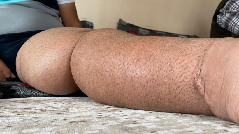 5 yıldır gitmediği hastane kalmadı: Kaza sonrası ayağı şişen gencin hayatı kabusa döndü! - Resim: 3