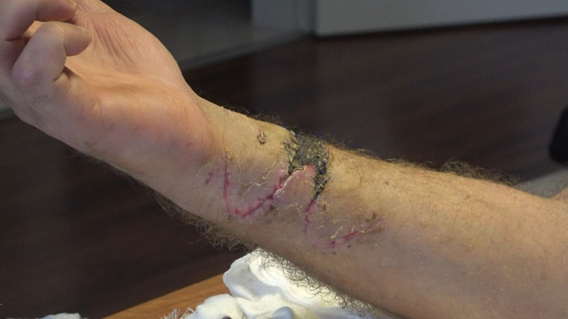 Bursa'da anlaşmazlık yaşadığı arkadaşına pusu kurup Pitbulla saldırdı 3 gün yoğun bakımda kaldı - Resim: 4