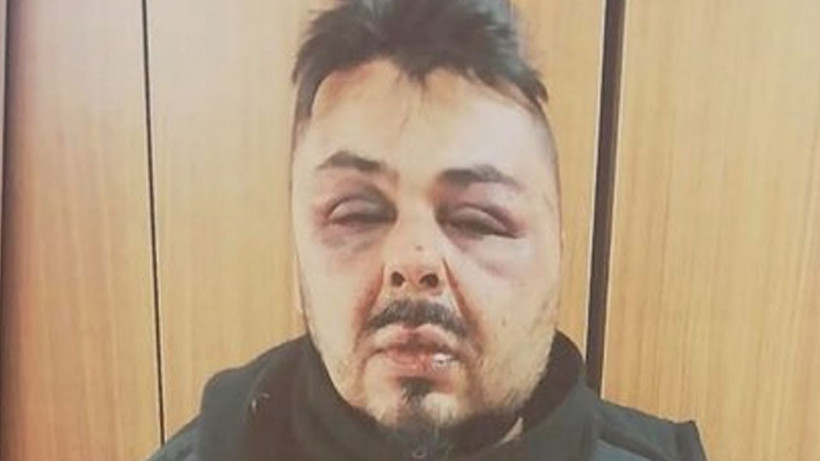 DM'den yürüyünce! Kemikleri kırılana kadar dayak yedi, Şarkıcı Hakan Akayran tanınmaz halde - Resim: 2