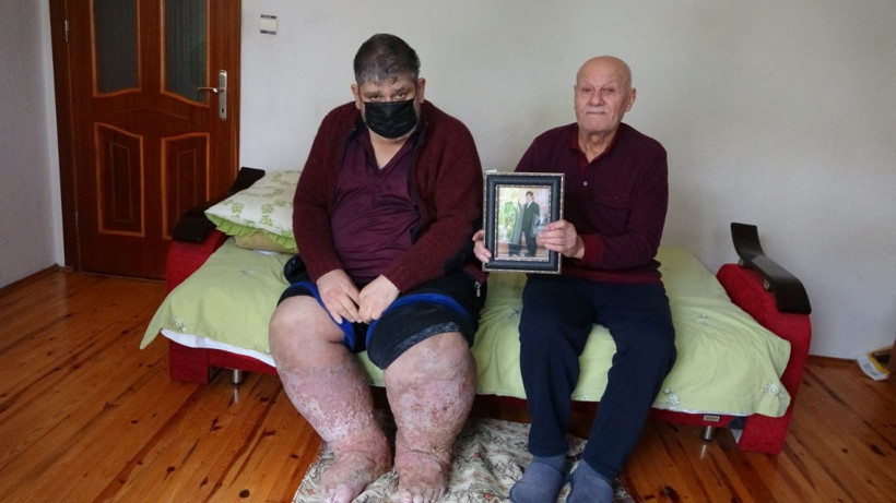 Sivrisinek hayatını karattı güvenlik görevlisi çürüyor! Bekleyen son gün geçtikçe yaklaşıyor - Resim: 2