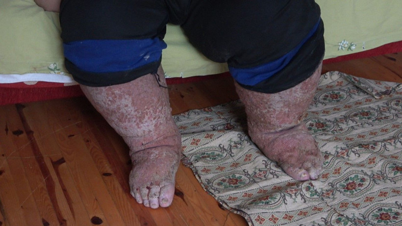 Sivrisinek hayatını karattı güvenlik görevlisi çürüyor! Bekleyen son gün geçtikçe yaklaşıyor - Resim: 4