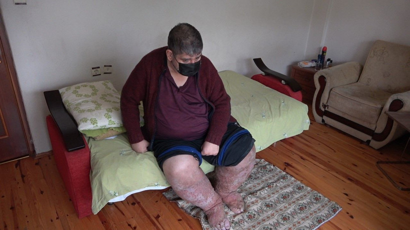 Sivrisinek hayatını karattı güvenlik görevlisi çürüyor! Bekleyen son gün geçtikçe yaklaşıyor - Resim: 1