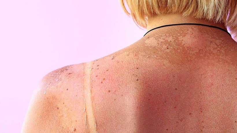 Güneş lekeleri korkulu ruyanız olmasın! Uzmanlar alınması gereken önlemleri açıkladı - Resim: 1