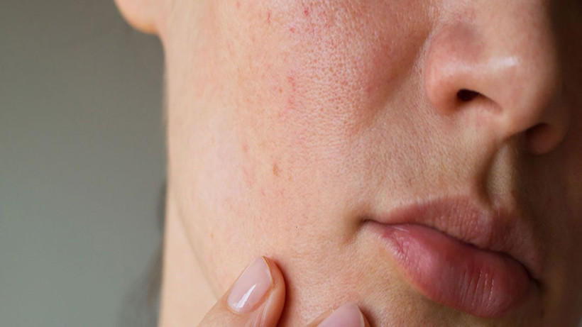 Güneş lekeleri korkulu ruyanız olmasın! Uzmanlar alınması gereken önlemleri açıkladı - Resim: 2