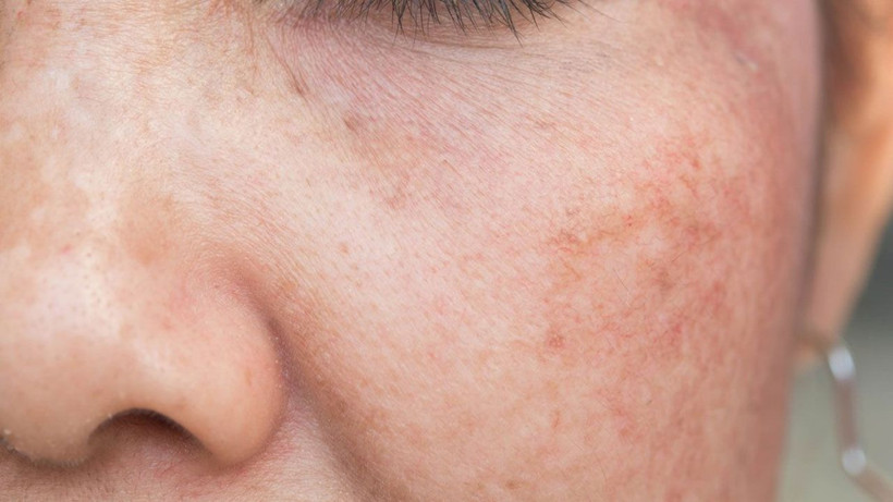 Güneş lekeleri korkulu ruyanız olmasın! Uzmanlar alınması gereken önlemleri açıkladı - Resim: 4