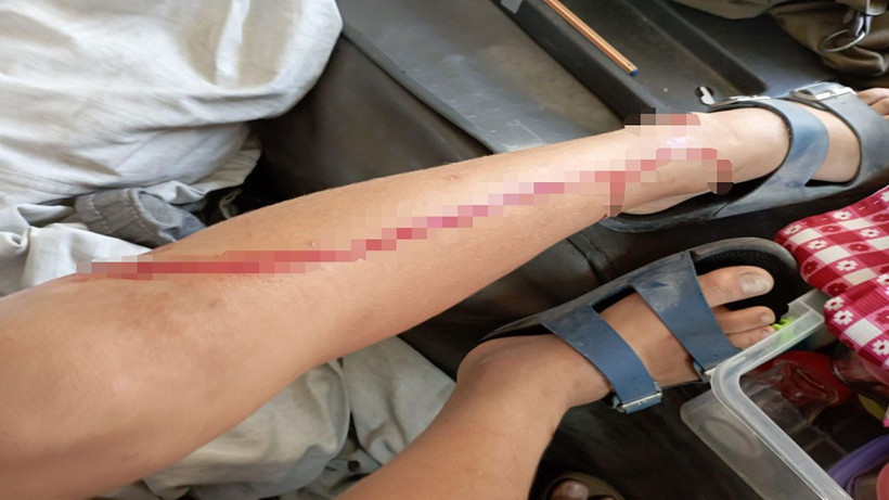 Başıboş köpekler Antalya'da küçük çocuğa dehşet yaşattı! 11 yaşındaki çocuğun baldırını kopardı - Resim: 4