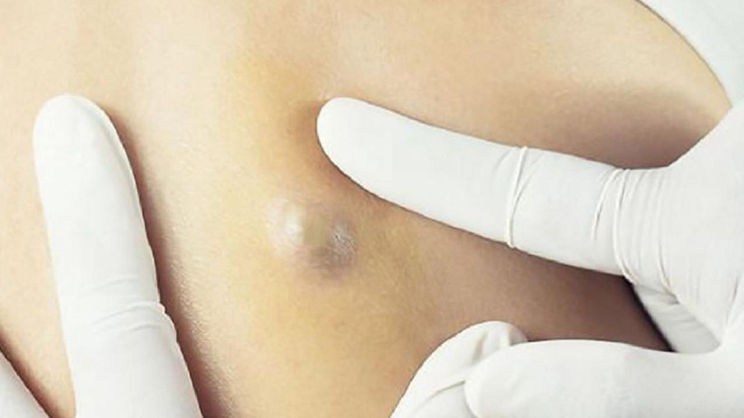 Bu belirtilere dikkat! Koltuk altı ve kasıkta görülüyor! - Resim: 2