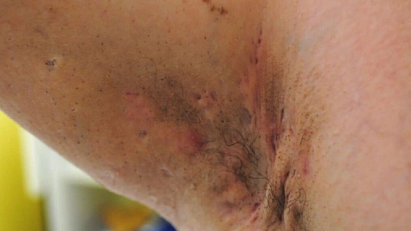 Bu belirtilere dikkat! Koltuk altı ve kasıkta görülüyor! - Resim: 4