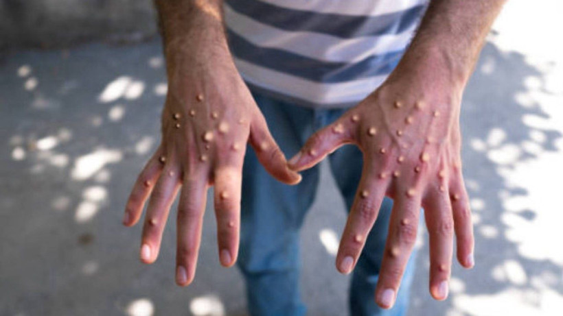 Gana'da M çiçeği vaka sayısı artıyor! - Resim: 2