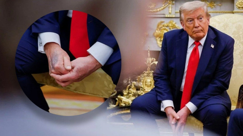 ABD Başkanı Trump’ın elleri mosmor oldu! Herkes ne oldu diye merak etti, Beyaz Saray işin aslını açıkladı - Resim: 4