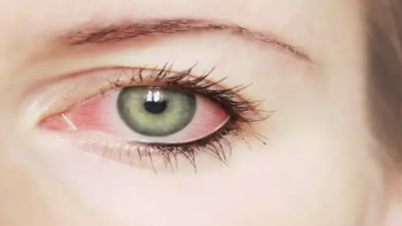 Gözde kaşıntıya dikkat! Bu hastalığın belirtisi olabilir... - Resim: 4