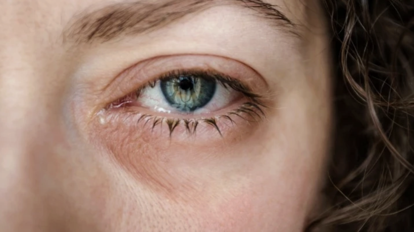 Gözde kaşıntıya dikkat! Bu hastalığın belirtisi olabilir... - Resim: 2