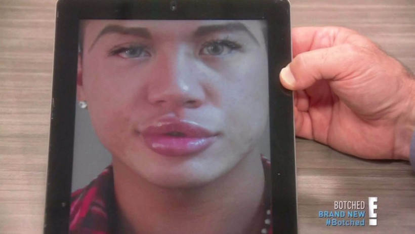 Estetik bağımlısı oldu dudakları kapanmıyor!  - Resim: 1