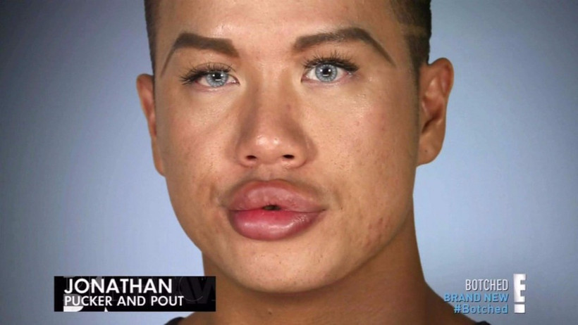 Estetik bağımlısı oldu dudakları kapanmıyor!  - Resim: 2